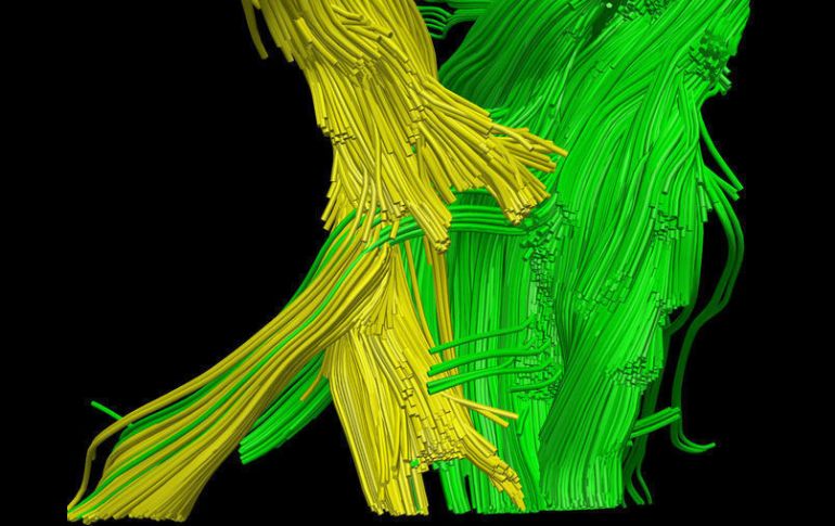 La imagen amarilla muestra las fibras nerviosas del cerebro dañadas. AP  /