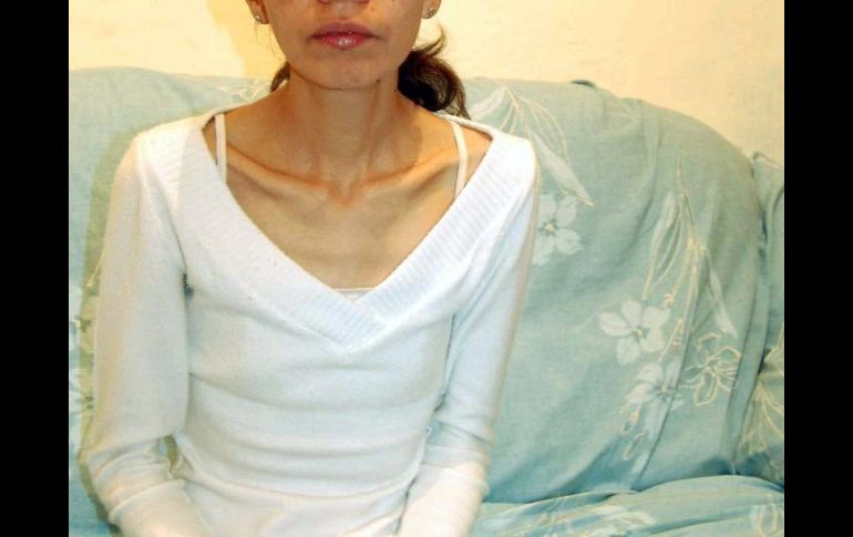 La moda puede ser mortal. En la foto: mujer que pesa 28 kgs. a causa de la anorexia. ARCHIVO  /