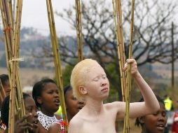 Actualmente no existe ningún tratamiento específico que logre producir la melanina de la cual carecen los albinos. ARCHIVO  /