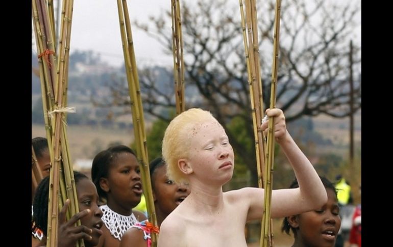 Actualmente no existe ningún tratamiento específico que logre producir la melanina de la cual carecen los albinos. ARCHIVO  /