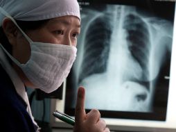 La tuberculosis mata a 1.5 millones de personas en todo el mundo cada año. AP  /