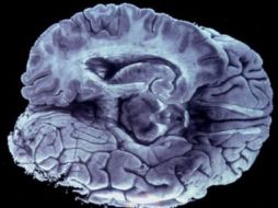 Hasta ahora los doctores estudiaban las imágenes cerebrales ''a simple vista''. ARCHIVO /