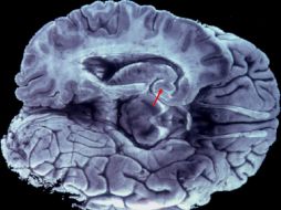 La fotografía muestra las lesiones histopatológicas características de la enfermedad de Alzheimer en el cerebro. EFE  ARCHIVO  /