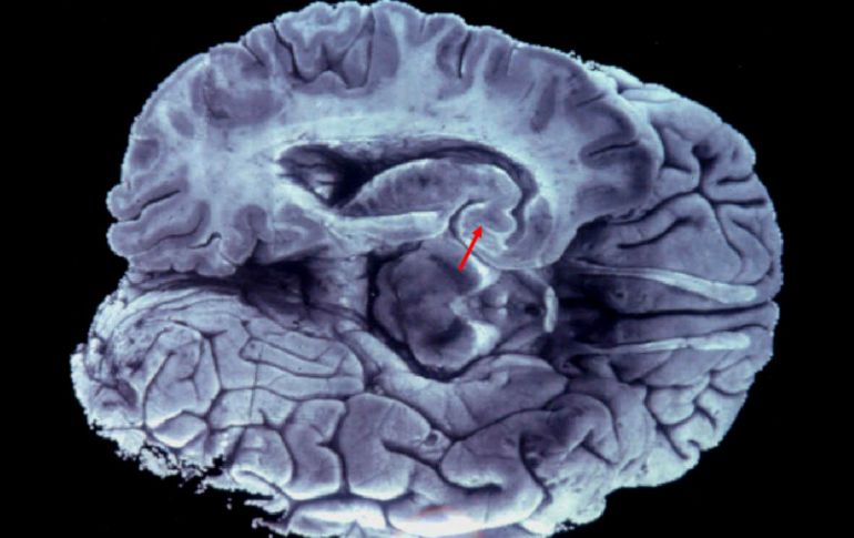 La fotografía muestra las lesiones histopatológicas características de la enfermedad de Alzheimer en el cerebro. EFE  ARCHIVO  /