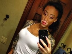 La modelo canadiense Winnie Harlow triunfa en las pasarelas pese a padecer vitiligo. INSTAGRAM / Winnie Harlow