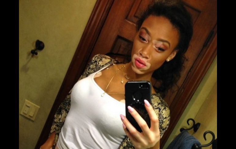 La modelo canadiense Winnie Harlow triunfa en las pasarelas pese a padecer vitiligo. INSTAGRAM / Winnie Harlow