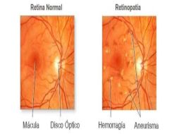 Diferencias entre un ojo sano y uno con retinopatía. TWITTER / ‏@opticaaltamirA