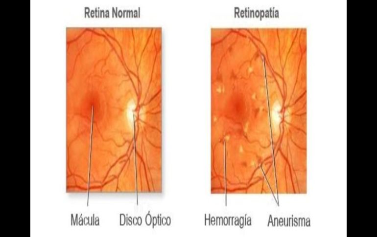 Diferencias entre un ojo sano y uno con retinopatía. TWITTER / ‏@opticaaltamirA