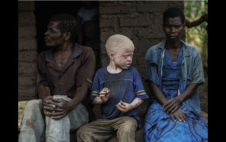 La población albina en Malaui y Tanzania sufre de constantes ataques, por lo que Amnistía Internacional pidió leyes para su protección. AFP / ARCHIVO