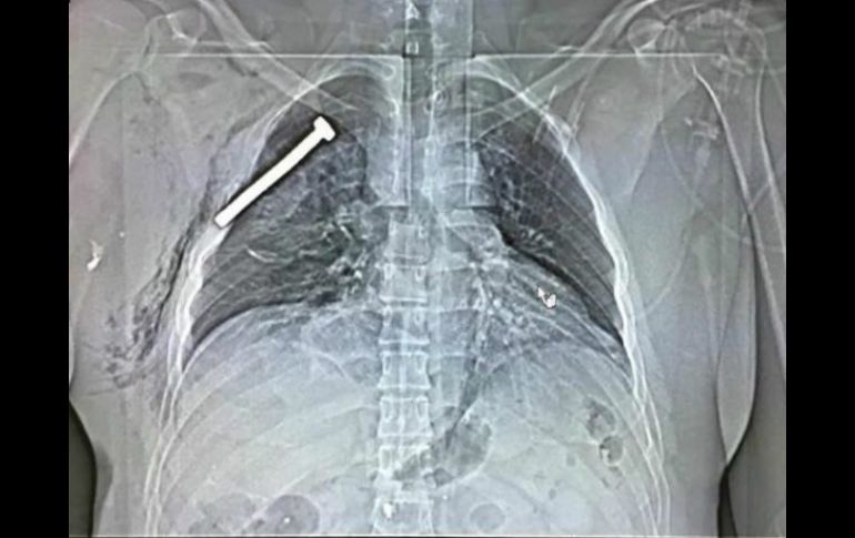 Imagen de una radiografía de una de las víctimas de los atentados de Bruselas, con un tornillo incrustado en el pecho. EFE / Stringer