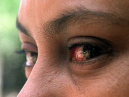 La falta de lubricación ocular puede generar conjuntivitis alérgica o infecciosa, así como alteraciones a nivel de la córnea. EL INFORMADOR / ARCHIVO