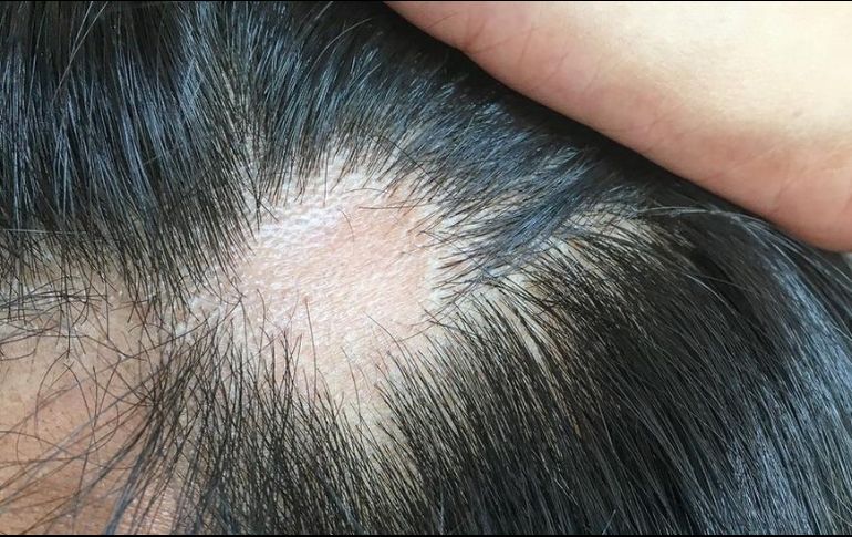 La caída del cabello causada por el coronavirus suele ser temporal. GETTY IMAGES