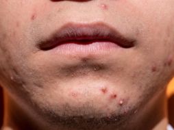 Las zonas más susceptibles al acné incluyen la cara, el cuello, la espalda, el pecho y los hombros, dejando marcas que pueden perdurar en la piel. Pixabay