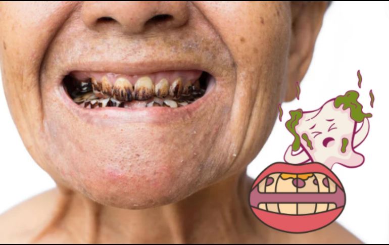 La acumulación de placa, caries, enfermedades periodontales y problemas de salud sistémica son solo algunos de los problemas que pueden surgir. CANVA