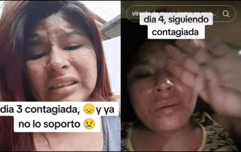 La joven al inicio aseguró estar padeciendo la viruela del mono, pero conforme fueron pasando los videos, en la caja de comentarios aclaró que se trataba de varicela. TIKTOK/ @jan09489