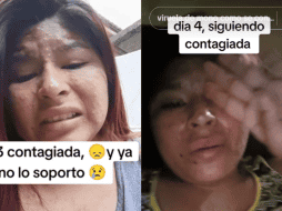 La joven al inicio aseguró estar padeciendo la viruela del mono, pero conforme fueron pasando los videos, en la caja de comentarios aclaró que se trataba de varicela. TIKTOK/ @jan09489